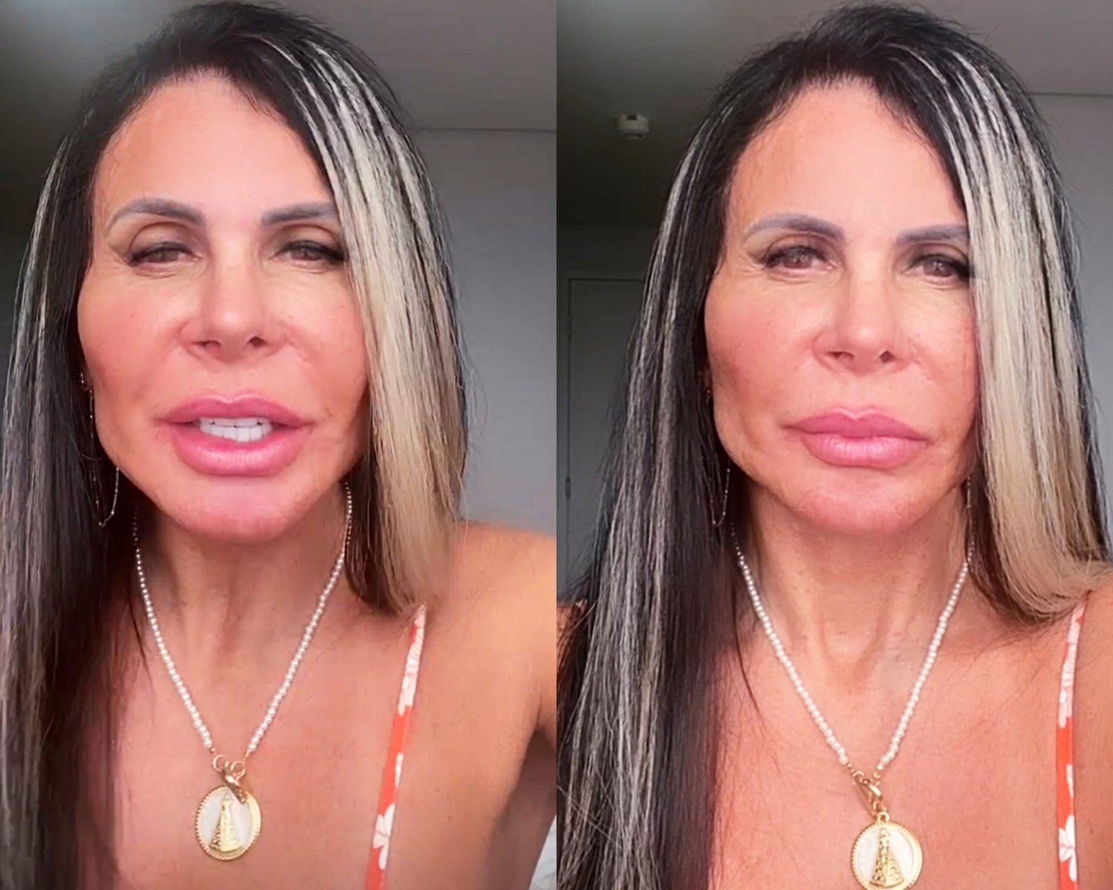 Gretchen realiza mais uma intervenção cirúrgica no rosto e comenta: "Tudo bonito"