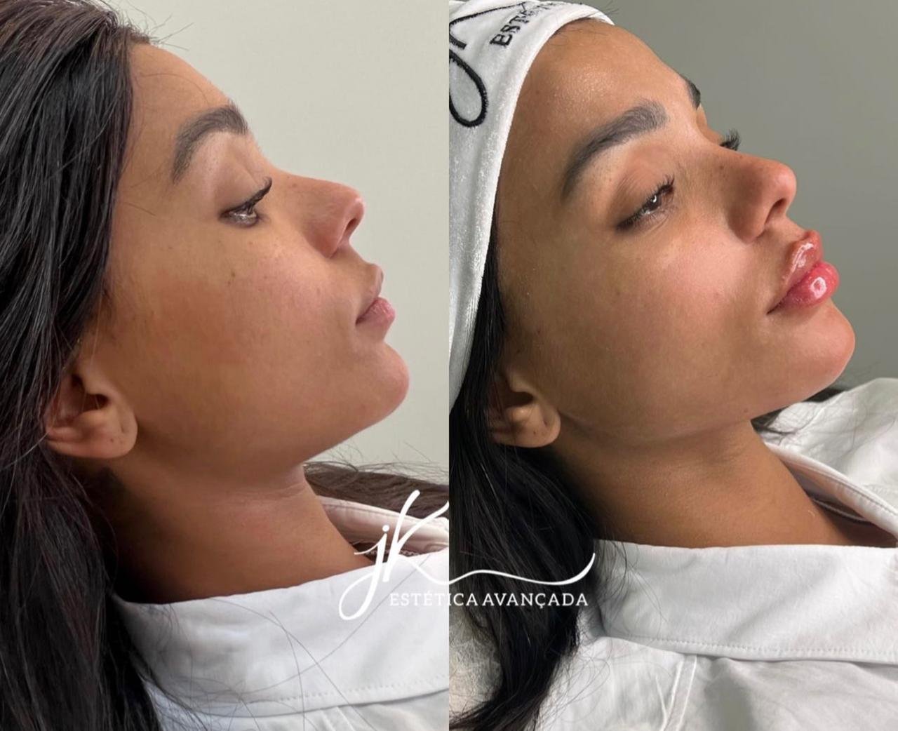 Brunna Gonçalves retoca harmonização facial e aumenta lábios