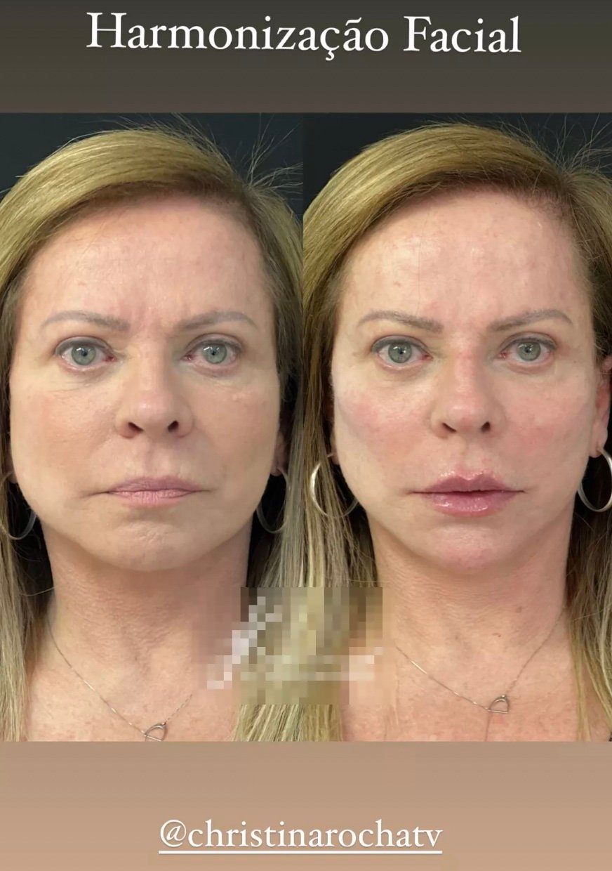 christina rocha mostra harmonização facial antes e depois