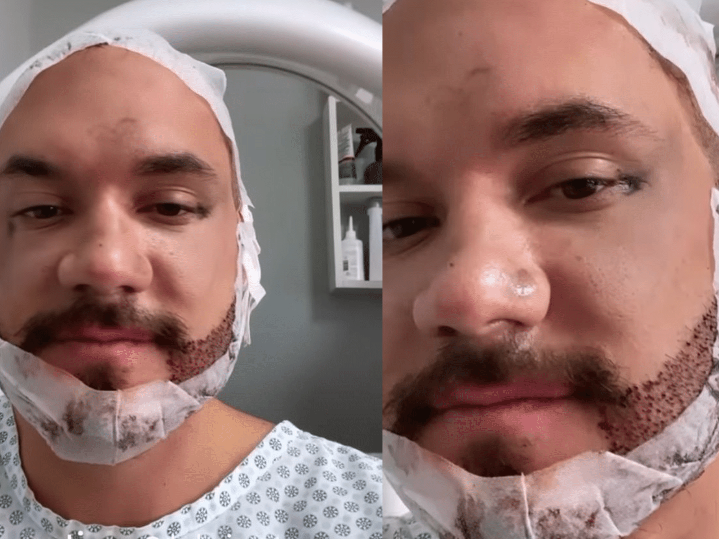 Eliezer transplante capilar