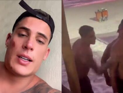 Imagem do post: Apanhou! Tiago Ramos surge com rosto machucado após brigar com homem na praia: “Provocou”; veja vídeo