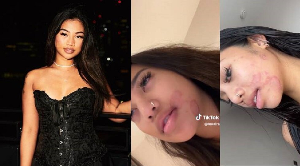 mulher micose compartilhar pinceis