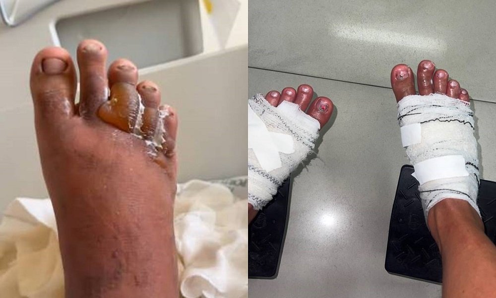 influencers queimaduras prova anderson neiff