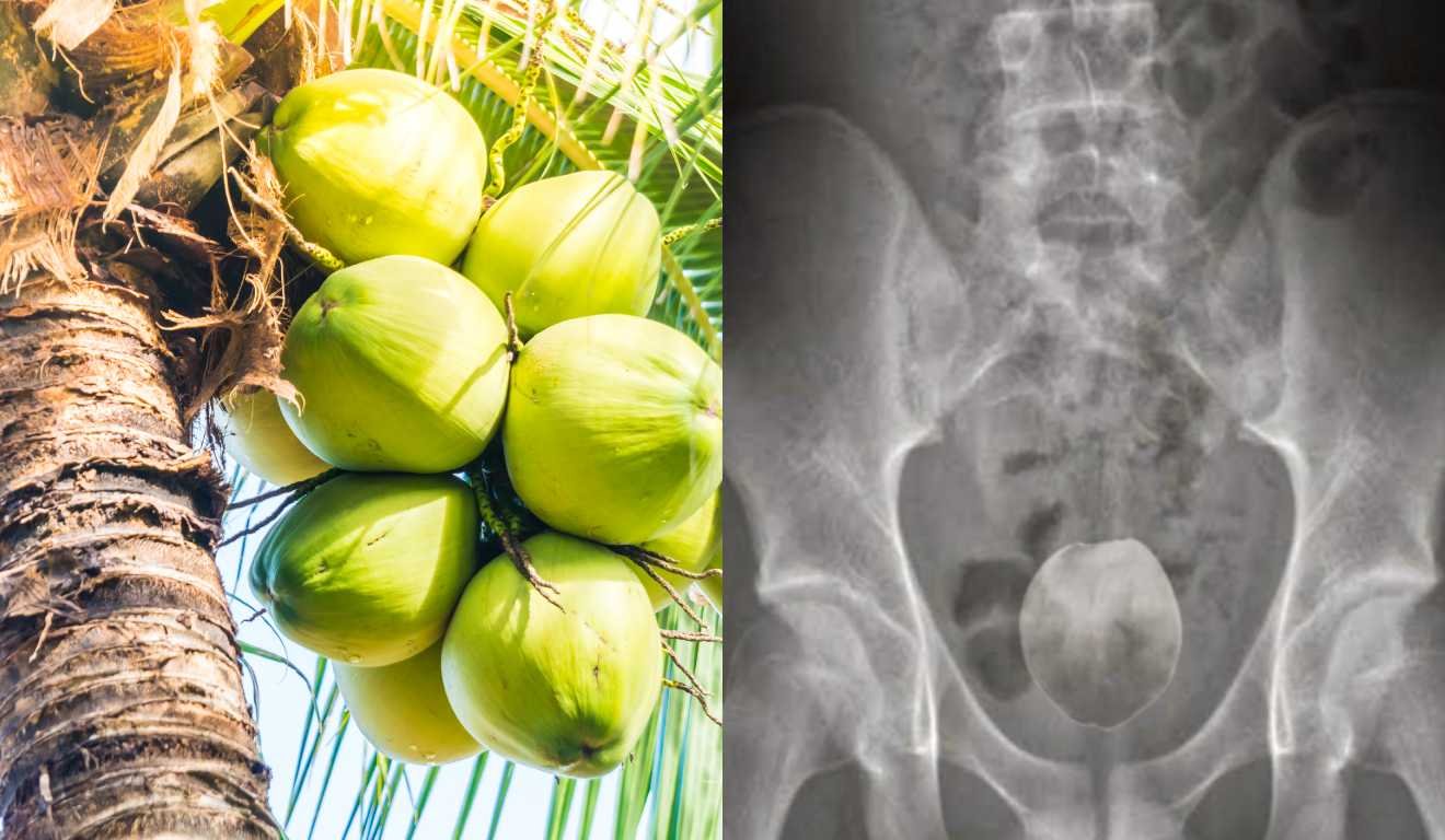 Homem é internado para fazer cirurgia perigosa após introduzir um coco em seu ânus no MT
