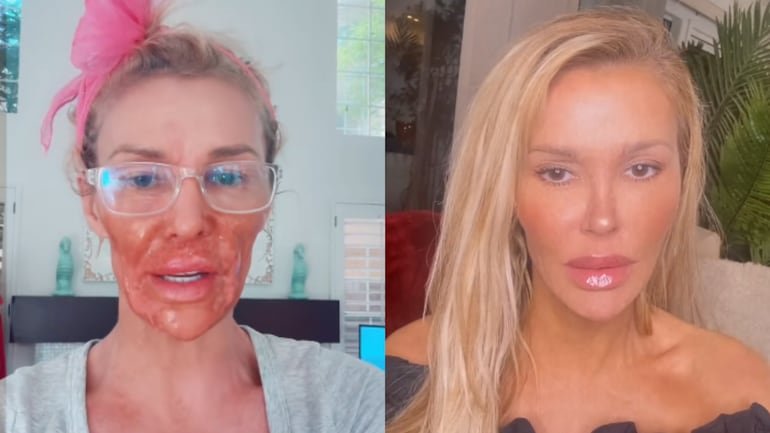 Ex-reality sofre queimaduras graves no rosto após tentar “expulsar parasita” com creme depilatório