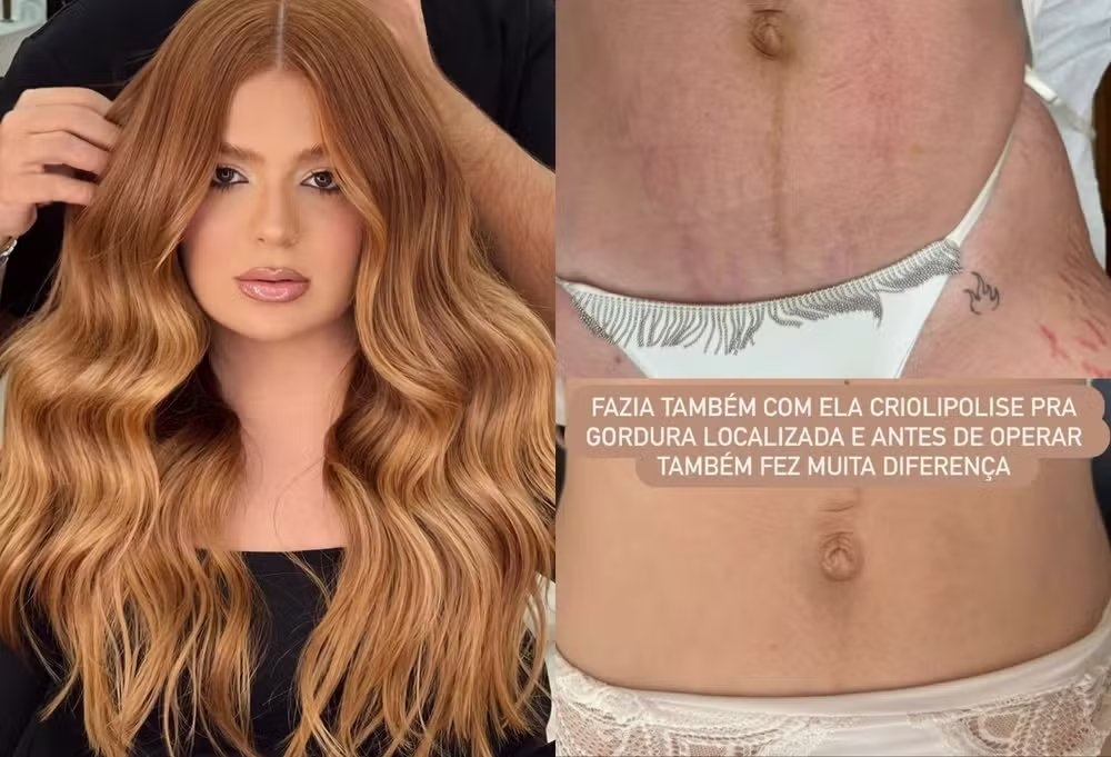 Viih Tube revela combo de cirurgias após emagrecer 21kg: “Fiz até tratamento para estrias”