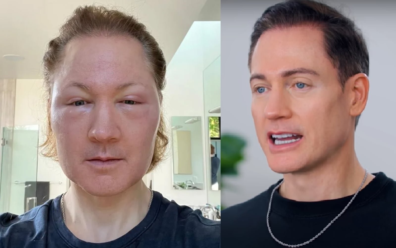 Bilionário que quer "ser jovem para sempre" tem rosto deformado após tratamento estético: o que aconteceu com Bryan Johnson?