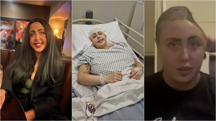 Mulher perde parte do crânio após cair de escada durante noite de bebedeira