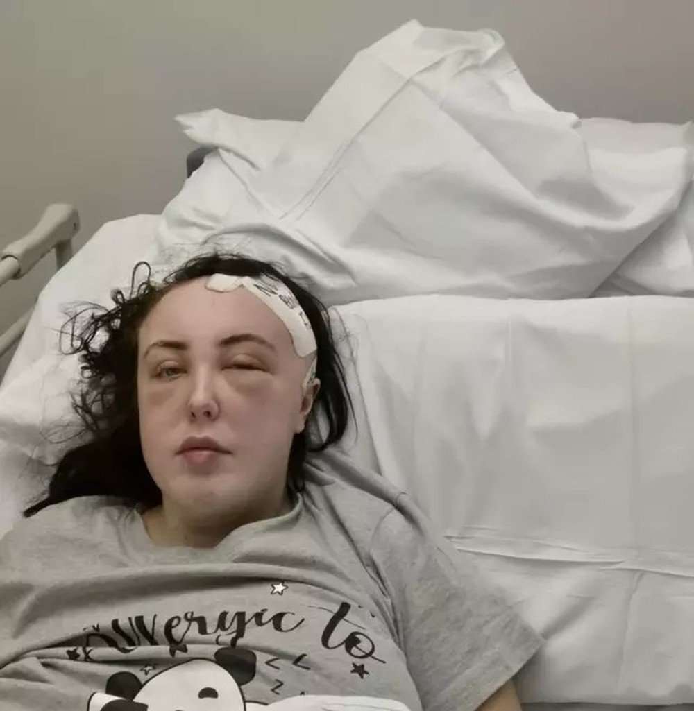 Mulher perde parte do crânio após cair de escada durante noite de bebedeira