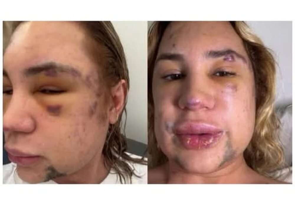 Influenciador Junior Dutra morre meses após complicações de procedimento estético