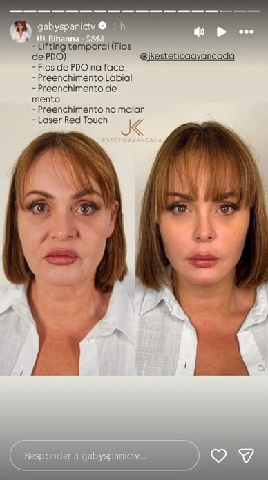 Gaby Spanic exibe resultado de rejuvenescimento facial e impressiona fãs com antes e depois