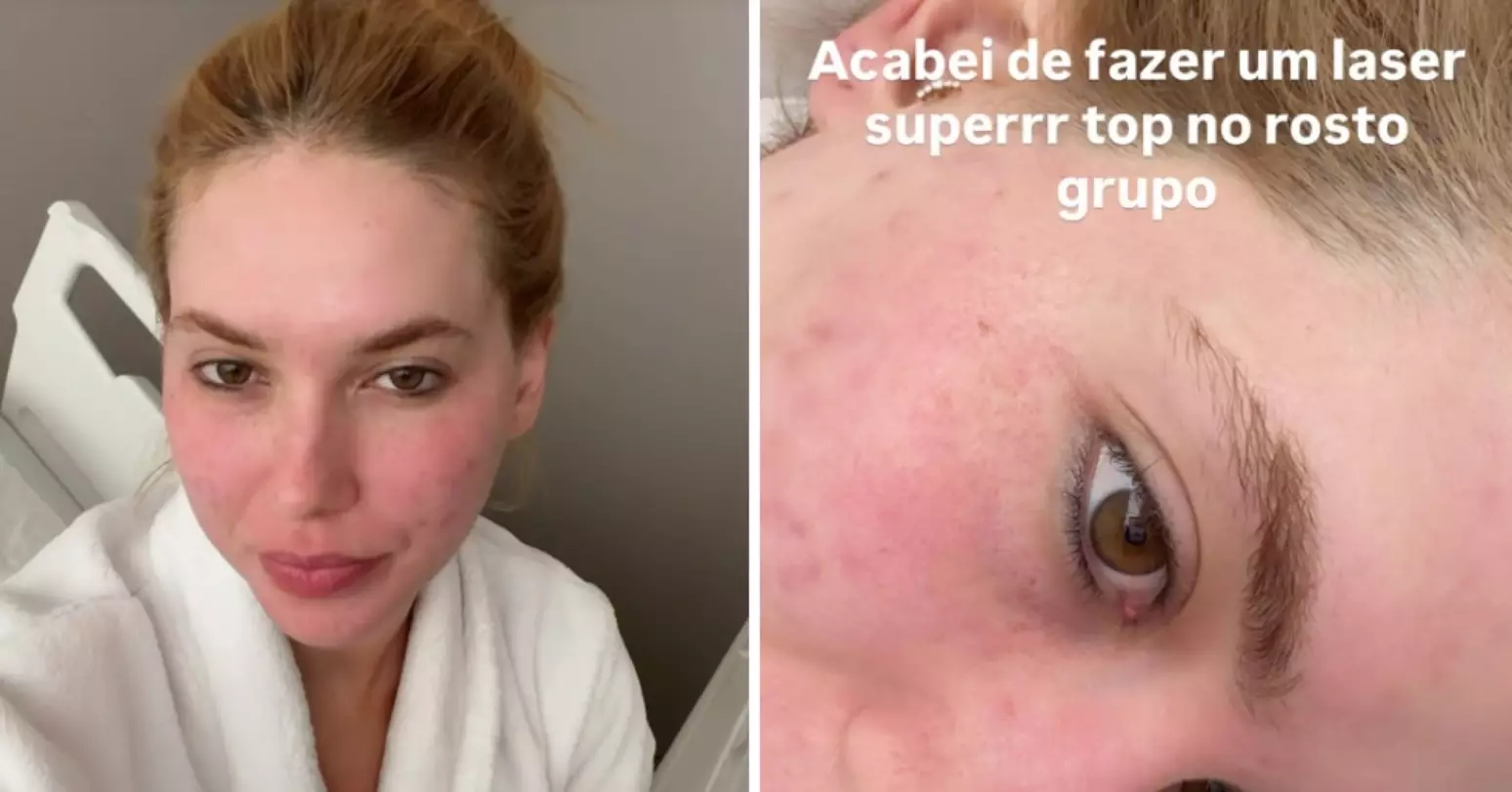 Virgínia Fonseca nega cirurgia plástica e explica procedimento a laser para tratar cicatrizes de acne