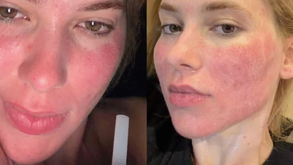 Após vermelhidão intensa, Virginia Fonseca celebra início do “glow up” após procedimento facial; veja evolução