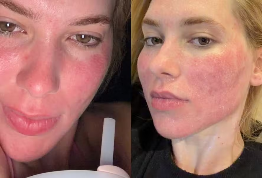 Após vermelhidão intensa, Virginia Fonseca celebra início do “glow up” após procedimento facial; veja evolução