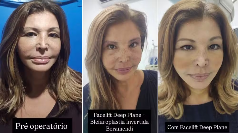 Roberta Close, aos 60 anos, recorre a harmonização facial e revela rotina de cuidados 52 Roberta Close, aos 60 anos, recorre a harmonização facial e revela rotina de cuidados