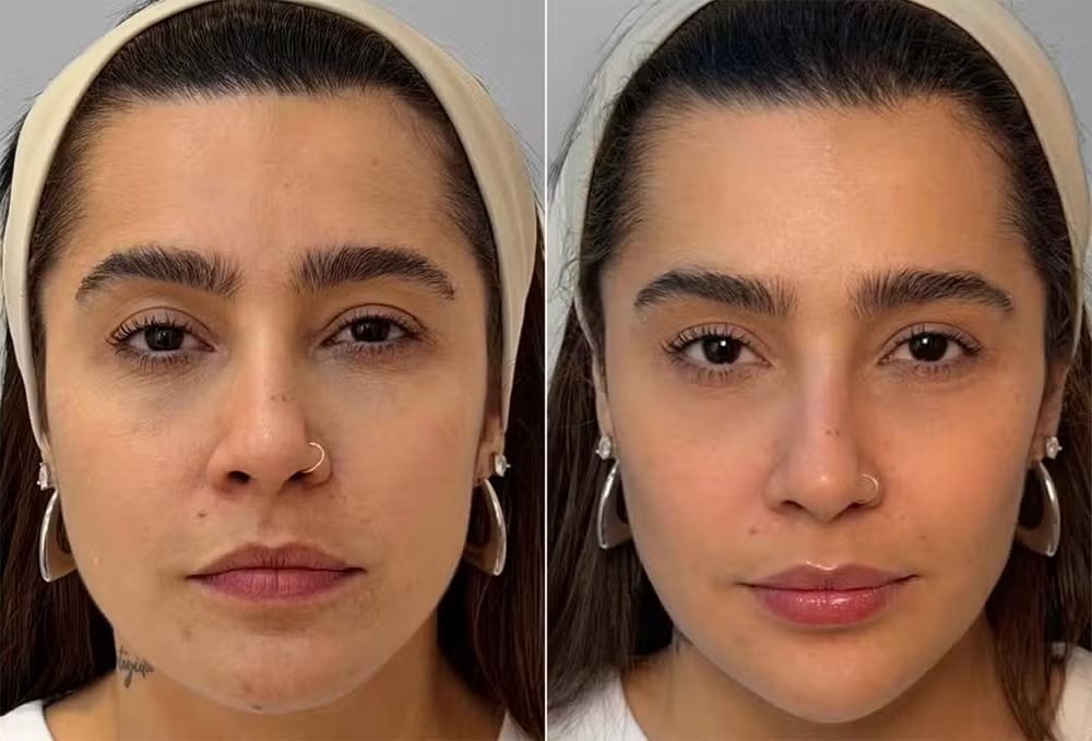Lauana Prado passa por harmonização facial e clínica revela resultado com antes e depois