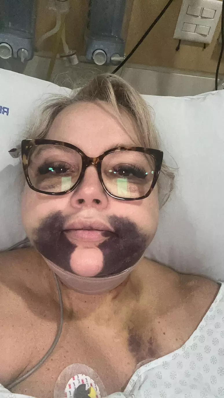 Advogada fica com rosto deformado após procedimento estético e dentista é denunciada pelo MP do RJ