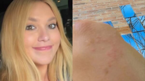 Virginia Fonseca revela crise de pele causada por estresse e ansiedade 2 Virginia Fonseca revela crise de pele causada por estresse e ansiedade