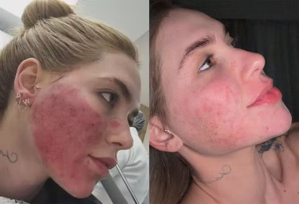 Virginia mostra evolução do rosto três dias após procedimento estético intenso