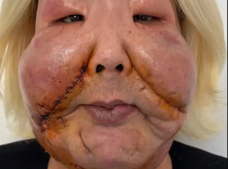 Médico divulga detalhes da segunda cirurgia para retirada de óleo mineral do rosto de Juju do Pix