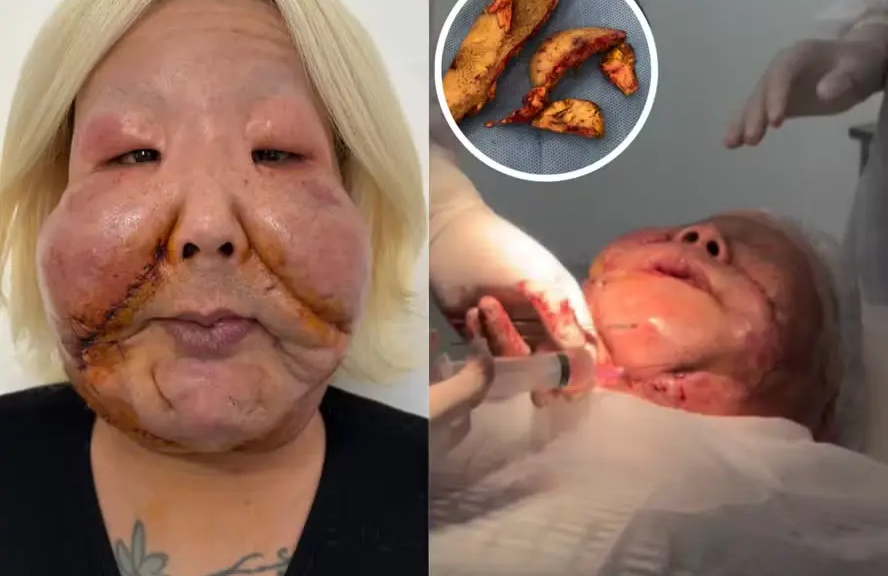 Médico divulga detalhes da segunda cirurgia para retirada de óleo mineral do rosto de Juju do Pix