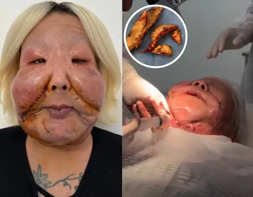 Médico divulga detalhes da segunda cirurgia para retirada de óleo mineral do rosto de Juju do Pix