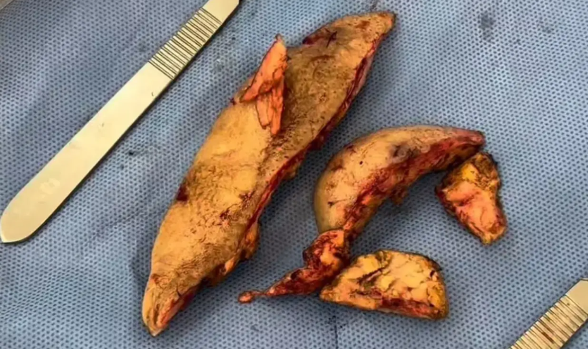 Médico divulga detalhes da segunda cirurgia para retirada de óleo mineral do rosto de Juju do Pix