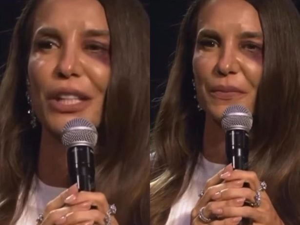 Ivete Sangalo passará por cirurgia após queda em casa 45 Ivete Sangalo passará por cirurgia após queda em casa