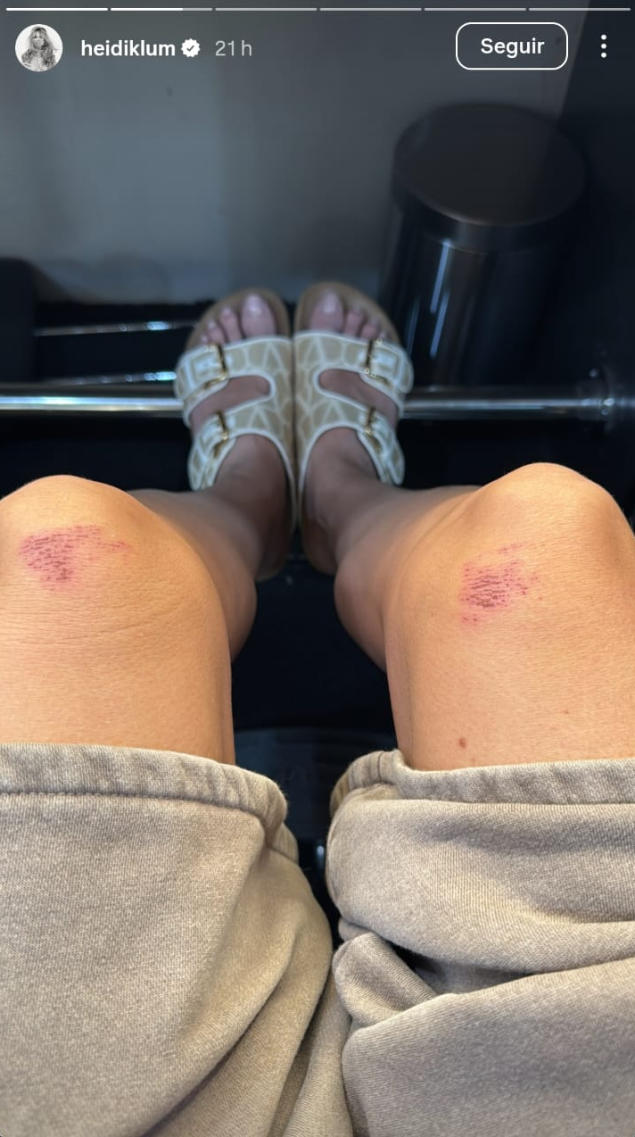 Heidi Klum revela machucados após usar vestido moldado no Grammy 2026