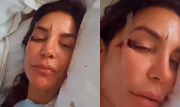 ivete sangalo rosto machucado