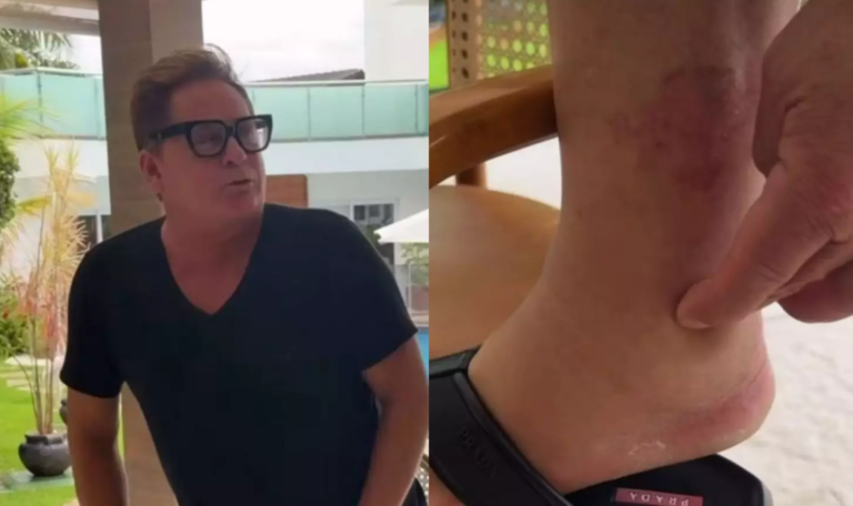 Leonardo viraliza ao brincar sobre pé inchado, culpa a cachaça e arranca risadas da web