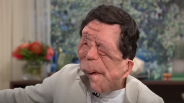 Ator Adam Pearson chama atenção e aumenta interesse sobre a neurofibromatose 1 Adam Pearson