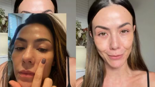 Após crise alérgica, influenciadora revela causa