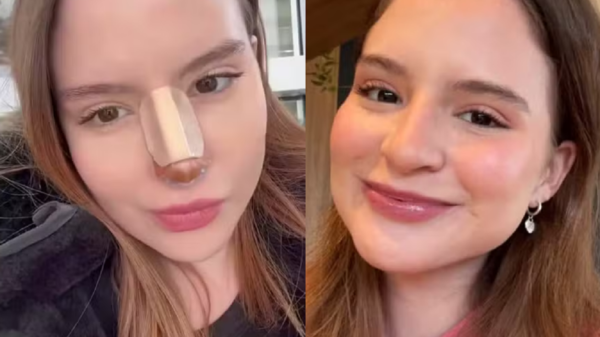 Sophia Valverde faz rinoseptoplastia