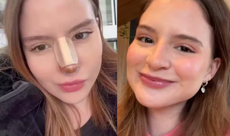 Sophia Valverde faz rinoseptoplastia