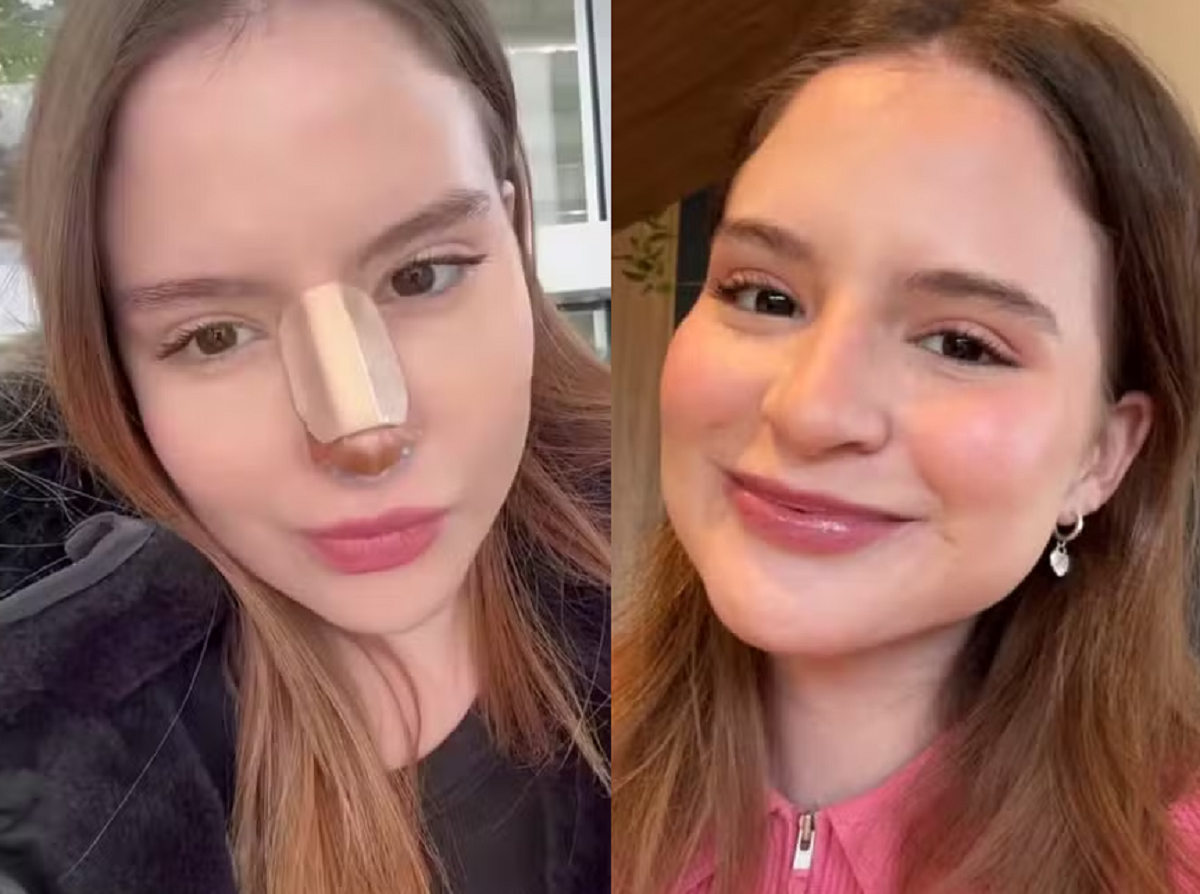 Sophia Valverde faz rinoseptoplastia