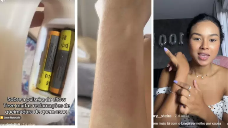 fãs luan santana queimaduras