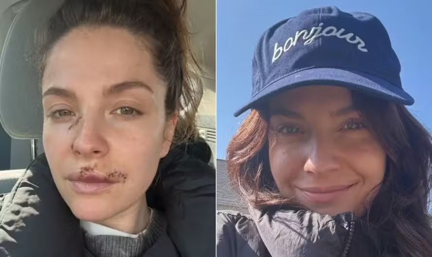 Atriz de série famosa teve tem parte do rosto arrancado em ataque de cachorro e mostra ferimentos