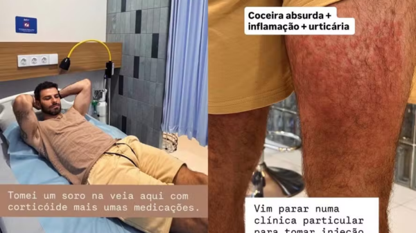 Ator brasileiro é hospitalizado na Indonésia após ataque de ácaros 1 lucas internado