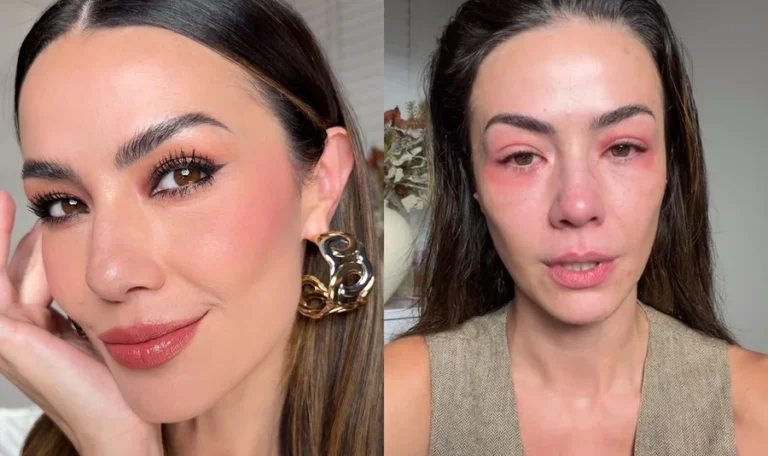 taise dias de kler alergia