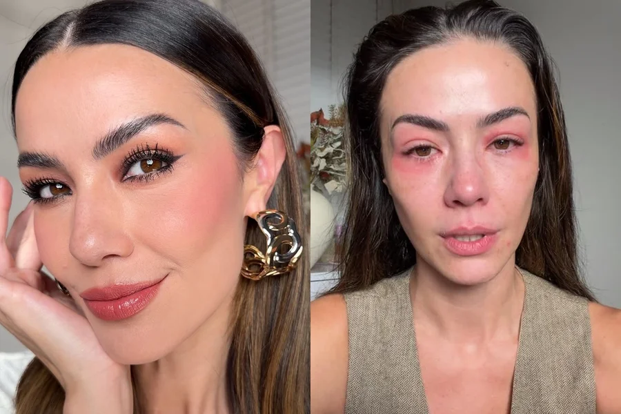 taise dias de kler alergia