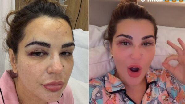 Deolane surge com hematomas no rosto e assusta web