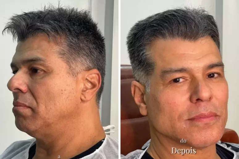 Maurício Mattar faz harmonização facial e resultado surpreende; veja o antes e depois 47 image
