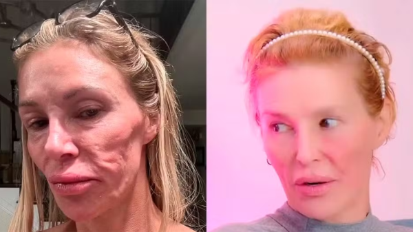 Estrela de reality que teve o rosto 'derretido' por parasita é hospitalizada após fazer tratamento que aprendeu no TikTok 11 mulher rosto derretido