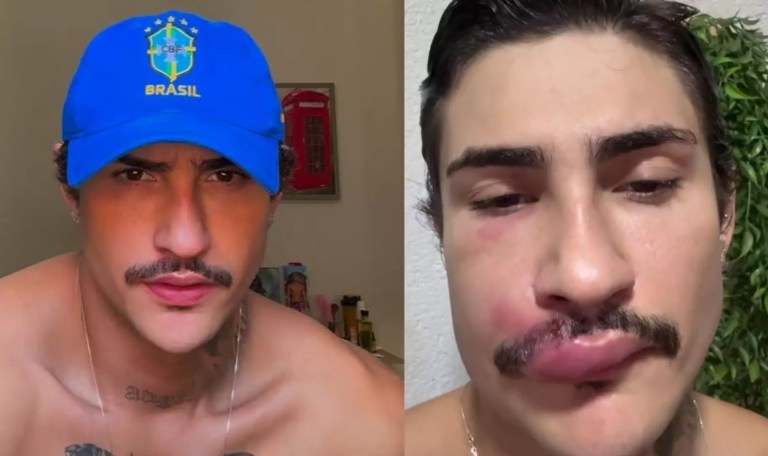 Influenciador Ken de CG é internado após infecção causada por espinha no rosto 47 image