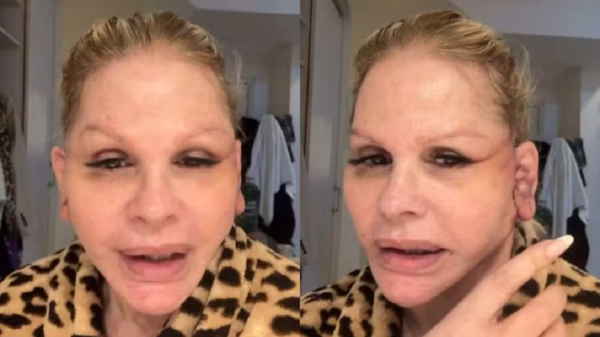 Monique Evans atualiza recuperação após cirurgia facial e diz que banco não reconheceu seu rosto 1 Monique Evans