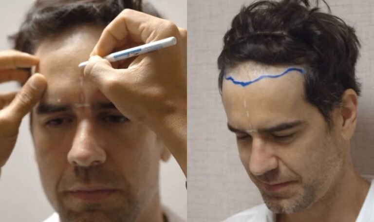 Marcos Pitombo realiza transplante capilar com técnica sem raspagem; veja vídeo 47 design sem nome 4 (4)