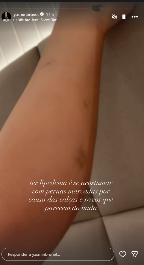 Yasmin Brunet mostra hematomas nas pernas e relata efeitos do lipedema 47 image