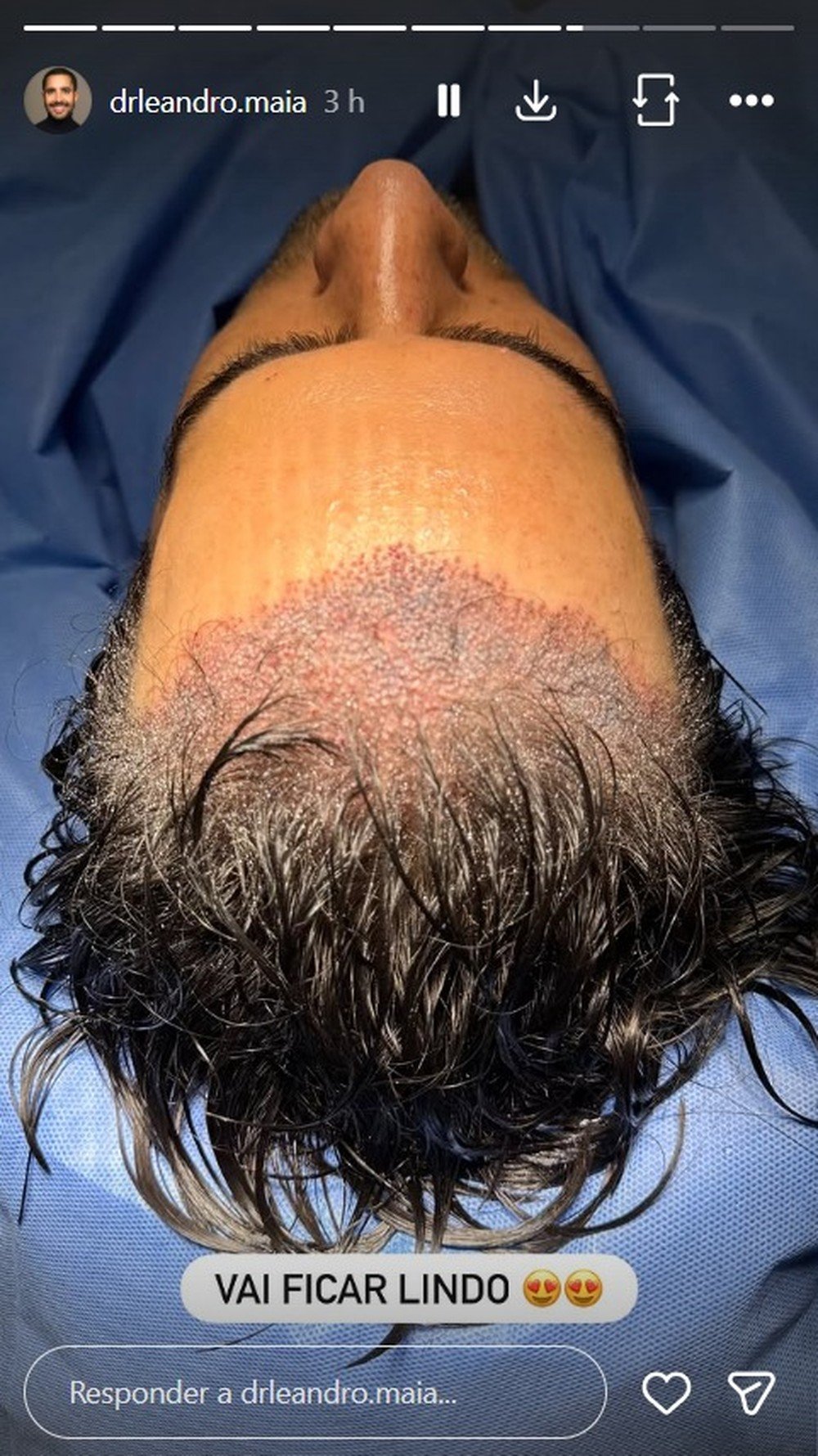 Marcos Pitombo realiza transplante capilar com técnica sem raspagem; veja vídeo 47 whatsapp image 2026 08 12 at 23.25.16