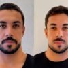 Ex-BBB Maike comenta repercussão de harmonização facial: "Tava ruim, já"